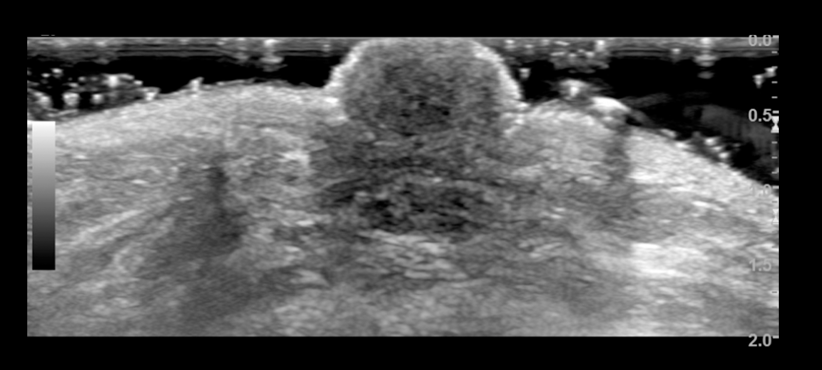 Ultrasound of Normal Breast Anatomy